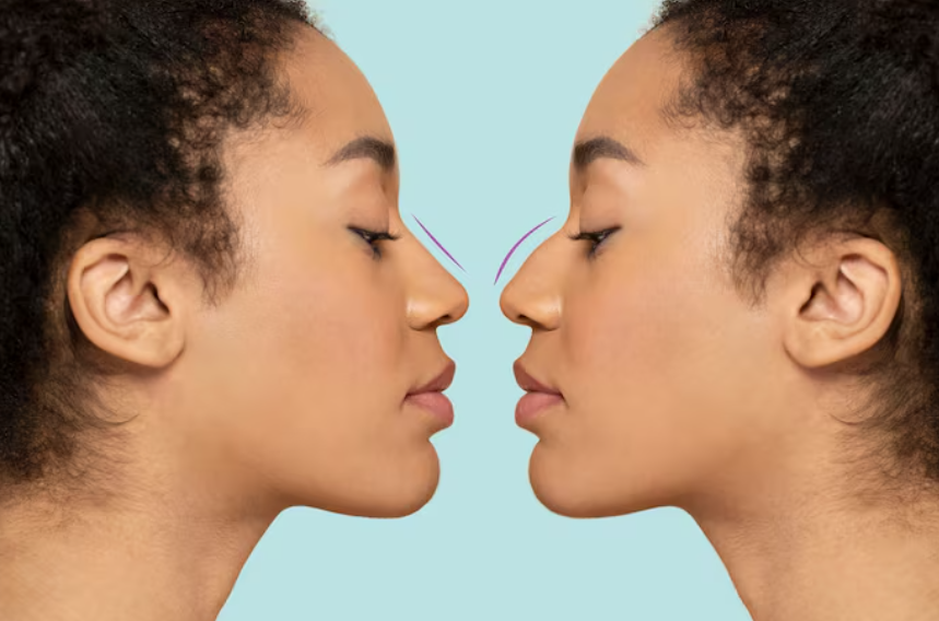 Non Surgical Rhinoplasty vs Surgical